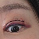 1 | 쌍꺼풀 재수술 1년 후기(두 줄 따기, 눈매교정)