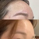 아비 | 강남 여드름 피부과 아비클리어 후기 │ 여드름레이저 효과 솔직 정리