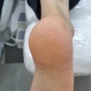 하이푸스춘천 네이버블로그