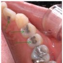 의미없는 아말감-치료 받지 않은 치아가 더 양호 이미지