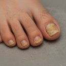 메디솔루션 | 무좀 발냄새 관리 풋스프레이: 메디케이 클리어솔루션 사용 후기 (편안하고 쾌적한 사용 가능)