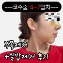 멍발머리 | [광고X] 부산 혼자 코수술 후기 2탄 | 4~7일차 부목 제거 + 실밥 제거 + 붓기 변화 (리얼사진)