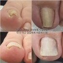 아델리오 네일&문제성손발톱 응암역촌점 네이버블로그