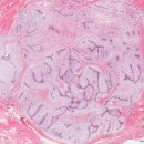 섬유선종[fibroadenoma] 이미지