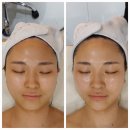 다온수지 | [내돈내산/후기] 살리는 윤곽술 후기 (용인 수지 다온뷰티)