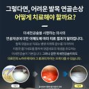 박리성골연골염 더 깊어지기 전에 발목수술명의와 함께 이미지