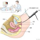 방광내시경 [Cystoscopy] 이미지