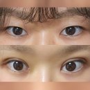 해바라기약국 | 부산 서면 쌍수 솔직후기 부분절개+눈매교정 (1일차~일주일)