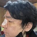 강남 논현역 자가늑코수술+비중격교정술(비염수술)전후 실비 2주차 남자코수술 잘하는 곳 후기