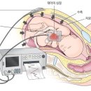 11260-2-37-18 | [B.2-18] 임신후기 임신37주차 증상 및 초음파, 역아, 태동검사