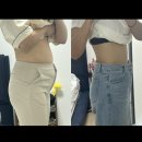 양이멍이 | 범계역 복부 지방추출주사2-3주차 후기 Q&amp;A(멍, 통증, 붓기, 뭉침)아랫배 무한람스 옆구리