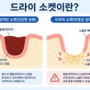 리플란트치과의원 | 부산완전매복사랑니 발치 후 붓기와 통증, 언제까지 정상일까?