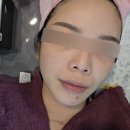 정관에스(S)한의원 | [홍대 한의원] 해율한의원 여드름흉터 케어 고민이라면 추천 후기