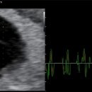 난황 8mm·심장박동 99bpm☆유산방지주사 맞고 온 임신 초기 후기
