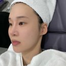 ADVANCE | 왕십리피부과 :: V-RO ADVANCE 팔자주름 리프팅 후기