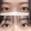 내돈내산 짝짝이 쌍커풀 압구정 퀵매몰 수술 후기 (결과물 중심)