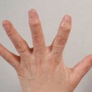 손가락 마디 통증 (퇴행성 관절염, 손가락 류마티스 관절염) 이미지