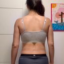 (주)이오글로벌 | 강남 지방분해주사효과 이오팻 전후비교