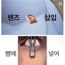 tooth in eye surgery 이미지