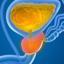 VIVE PC | Top urologists urge all men with prostate problems to see their new report