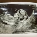 11650-16-142-11 | 임신 11주차 산부인과 후기 | 투명대 수치·배초음파·G-NIPT 기형아 검사 결정까지