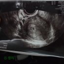 배란유도제 자연임신 5, 6, 7주 일기 초음파 증상 비용 I 덕천 아가애봄
