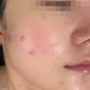 [청주/금천동] 힐에스테틱 :: 플라즈마 관리 후기 / 청주웨딩관리, 청주예신관리
