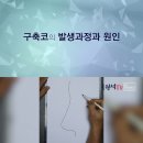 코성형 부작용인 구축코의 발생과정과 원인. 이미지