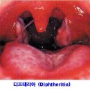 ■ 구내염(Stomatitis), 다양한 원인과 치료 방법 이미지