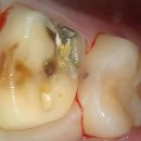 두려움을 제거하는 가장 빠른 방법 | 깊은 충치로 금니 빠짐과 뿌리염증으로 인한 잇몸물집 및 내려온 어금니 신경치료 후기