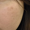 모델로피부과의원 | [마곡 피부과] 유앤아이의원,듀얼 올포유 &amp; 모공 올킬(포텐자+프락셀) 1회차 내돈내산 솔직리뷰