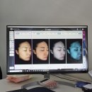 레이저 | 천안불당동피부과 크롬레이저 후기