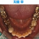 2024-03-0202 | 월배역 임플란트 , 문제가 생긴 치아 발치 즉시 임플란트