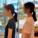 김해바른병원 | 김해 율하 필라테스, 1개월 만의 거북목 체형교정 변화