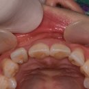 이경우치과의원 | 앞니 크라운 치과 치료 ,늙은 앞니를 젊게 바꿉니다. 블랙트라이앵글