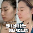숄리 흉터 재생크림 N통 째! 에스테틱 원장이 압출 후 7일간 발라본 찐 후기 보여드릴게요