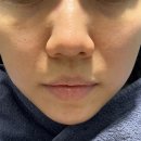 채운 | 압구정피부과 올리디아 스킨부스터 콜라겐주사 팔자주름 앞볼 채운 후기