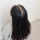 현재의 현 | 대구두피문신 대구SMP 내돈내산 제대로 받은 리얼 후기