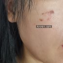 그린빌약국 | 광주 북구 미백관리 아임뷰티 피코토닝 후 흑자도 빼고 점까지 빼고