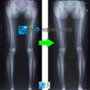 강남수재활의학과의원 | 오다리교정 깔창부터 발바닥 통증까지, 내 몸을 살리는 맞춤형 의료용 깔창의 비밀