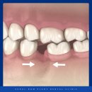서울봄플란트치과의원 | 송파구치과잘하는곳 치아 뿌리만 남아 있다면