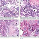 흰다리새우의 간췌장 (hepatopancreas)과 AHPND (조기폐사증후군)의 조직학적 변화 이미지