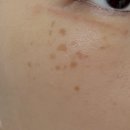 수원-1327 | [수원/용인/안산] ‘미작뷰티 수원점’ 기미잡티 제거 후기, 제로스팟 1회 후 10일 경과 후기