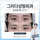 닥터로미성형외과의원 | 몽고주름 제거 ! 답답한 눈매를 시원하게 바꾸는 앞트임의 마법