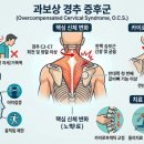 물리치료사가 알려주는 통증관리 | [물리치료사가 알려주는] 목 통증의 숨겨진 원인: 과보상 경추 증후군