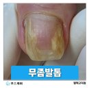 빠리바게트송탄점 | 평택 고덕 무좀발톱 관리 후기/ 노랗게 변색된 발톱, 이렇게 달라졌습니다