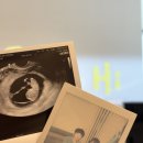 라라상사 | 에이치아이 여성의원 동결이식 1차수 성공 졸업 후기 (김나영 원장님, 시험관 주사 안아프게 맞는 팁)