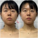 자연화장품，자연피부관리 | 서면 얼굴리프팅 연지동 피부관리, 자연스럽게 라인이 달라진 후기