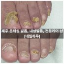 문제성 손발톱 전문관리 케어톱톱