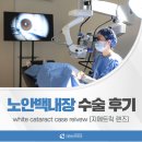 잘보는안과의원 | [CASE 리뷰] 판교잘보는연세안과 노안백내장 수술 후기 case reivew (지메트릭 렌즈)